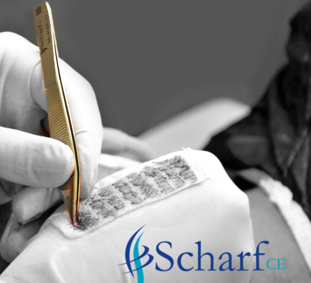 Scharf punch in a hair transplant procedure